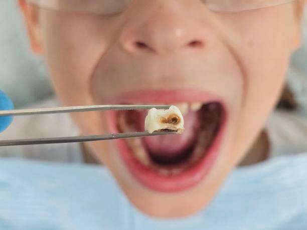 Best Emergency Wisdom Tooth Extraction in Oill, NE